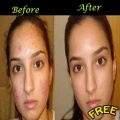 Get Rid Of Acne mobile app for free download