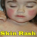 Skin Rash mobile app for free download